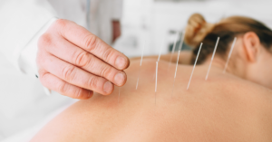 Did you know a physiotherapist can provide acupuncture?